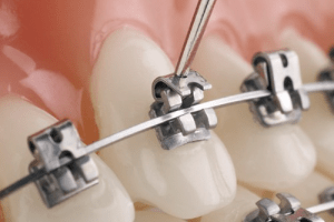 Bangalore, Dental, Traditional Braces Treatment &ndash; Orthodontic Care In Bangalore