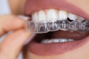 Bangalore, Dental, Traditional Braces Treatment &ndash; Orthodontic Care In Bangalore