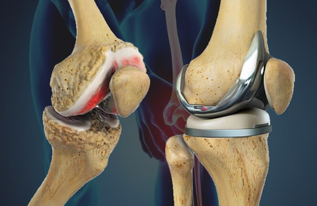 Hyderabad, Health, Which Hospital Provides You The Best Knee Replacement Surgery ?