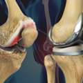 Which Hospital Provides You The Best Knee Replacement Surgery ?