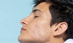 New York, Health, Deep Daily Cleanse For Congested, Breakout Prone Skin