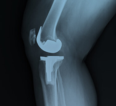 Mumbai, Health, Best Joint Replacement Surgery In India