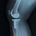 Best Joint Replacement Surgery In India