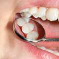 Natural Tooth Repair With Composite Fillings Edison