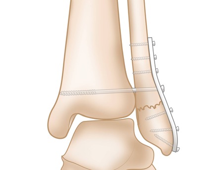 London, Health, Ankle Fracture Treatment