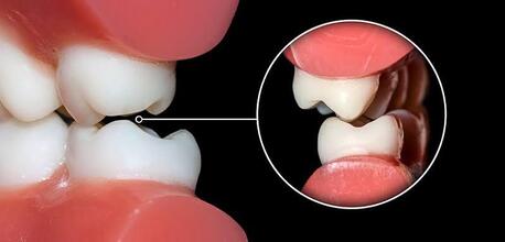 Jaipur, Health, Root Canal Treatment In Jaipur