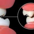 Root Canal Treatment In Jaipur