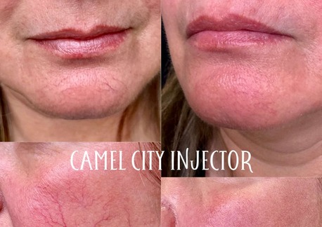 New York, Business, Skin Resurfacing Winston Salem Nc