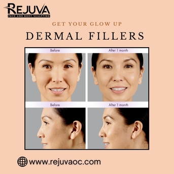 New York, Health, Dermal Fillers Newport Beach &ndash; Natural Volume & Youthful Contours