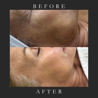 London, Beautician, Pigmentation Peel In West Kensington, London &mdash; Velvet Skin