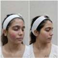 Best Acne Treatment In Thane At DNA Royal Aesthetic Clinic &ndash; Advanced Skin Care Solutions