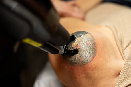 Boston, Business, Professional Best Tattoo Removal Boston Experts