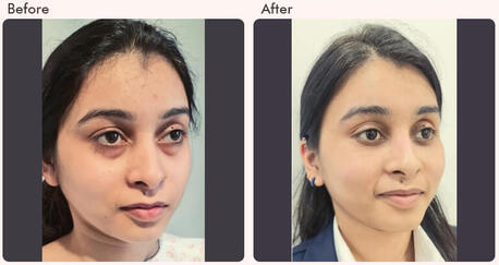 Mumbai, Health, Eyelid Surgery In Delhi - Dr Rajat Gupta