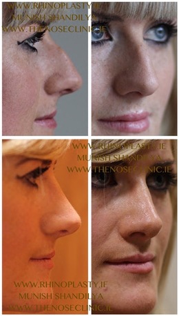 Dublin, Health, Rhinoplasty Ireland