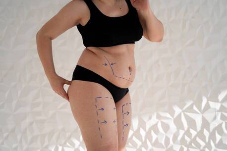 Cape Town, Health, Transform Your Body With Liposuction In Cape Town