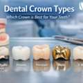 Find The Best Dental Crown Types At Dental Peace