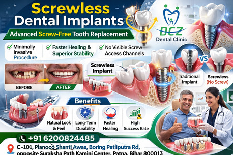Mumbai, Dental, Screwless Dental Implants | Advanced, Screw-Free Tooth Replacement Technology