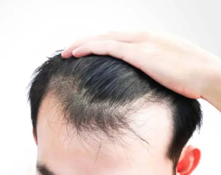 Gurgaon, Health, Best FUE Hair Transplant In Gurgaon At SB Trichology