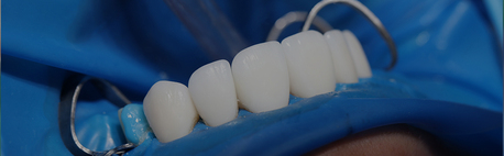 Mexico City, Dental, Dental Implants Tijuana Offers Natural-looking And Durable Teeth Replacements