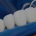 Dental Implants Tijuana Offers Natural-looking And Durable Teeth Replacements