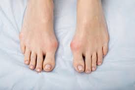 Singapore, Health, 4 Ultimate Benefits Of Bunion Treatment
