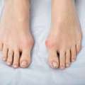 4 Ultimate Benefits Of Bunion Treatment