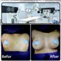 Best Breast Surgery In Jaipur - Dr. Nitesh Lamoria