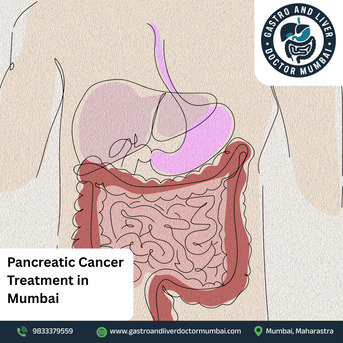 Mumbai, Health, Expert Pancreatic Cancer Treatment In Mumbai For All Stages