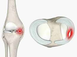 Singapore, Health, ACL Surgery In Singapore: Catching Up With Life Again