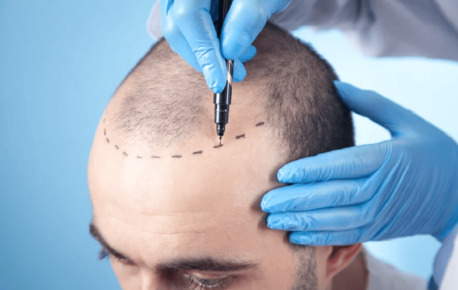 Mumbai, Health, Painless Hair Transplant Surgery In Mumbai At Hair And Shape Clinic