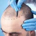Painless Hair Transplant Surgery In Mumbai At Hair And Shape Clinic