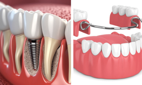 San Diego, Health, Are Dentures Implants Removable?
