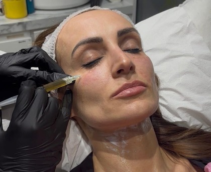 London, Beautician, Best Platelet Rich Plasma Treatment In Kentish Town