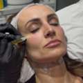 Best Platelet Rich Plasma Treatment In Kentish Town