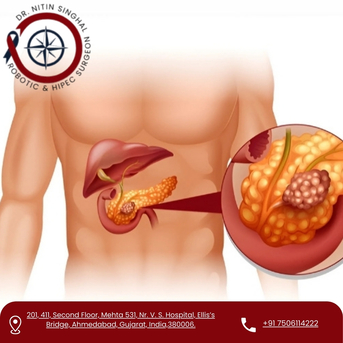 Ahmedabad, Health, Pancreatic Cancer Surgeon In Ahmedabad For Advanced & Safe Treatment