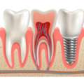 Top Benefits Of Dental Implants For Missing Teeth