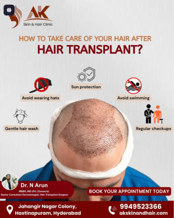 Hyderabad, Health, Expert Hair Transplant Treatment In Hastinapuram, Hyderabad