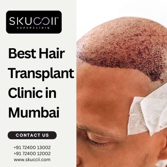 Mumbai, Business, Best Hair Transplant Clinic In Mumbai: Why Skuccii Supercliniq Stands Out