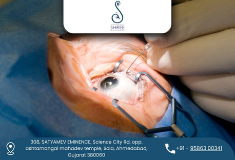 Ahmedabad, Health, Advanced Cataract Surgery In Ahmedabad At Shree Eye And Dental Hospital