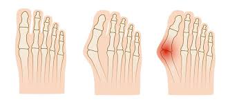 Singapore, Health, A Lighter Footprint: Discover Minimally Invasive Bunion Surgery