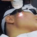 Laser Facial Treatment Nearby