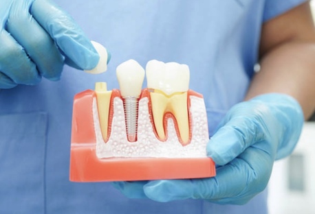 Auckland, Business, Dental Crowns Mt. Roskill, Auckland