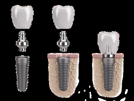 London, Health, Restorative Dentistry In Bristol | Expert Smile Restoration