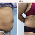Liposuction Surgery In Delhi - Dr Rajat Gupta
