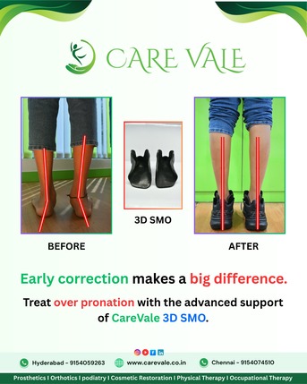 Hyderabad, Health, Free Artificial Leg In Hyderabad | CareVale Prosthetics