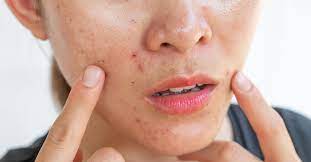 New York, Health, Lightweight Serum Designed For Oily And Acne-Prone Skin