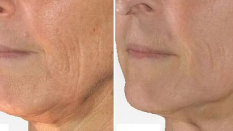 Toronto, Health, Best Nail Fungus Treatment Services