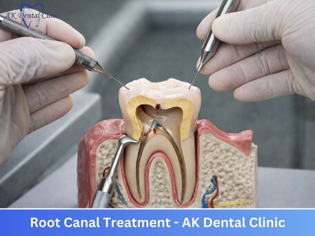 Mumbai, Dental, Best Pain-Free Root Canal Treatment In Mumbai | AK Dental Clinic