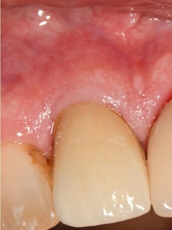 New York, Health, Restore Missing Teeth Quickly With Advanced Implant Solutions