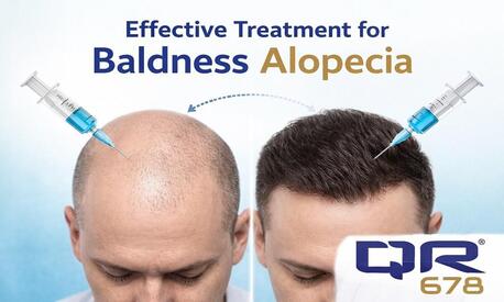 Mumbai, Health, Advanced Baldness Alopecia Treatment With QR678 Therapy